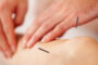 Dry Needling Acupunture For Leg Massage.