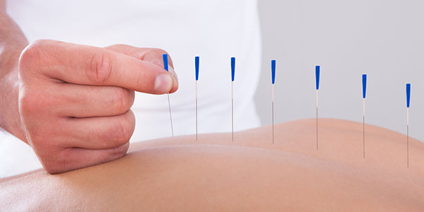 acupuncture