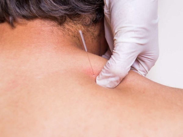 Physiotherapist Doing A Dry Puncture Treatment For His Patient.