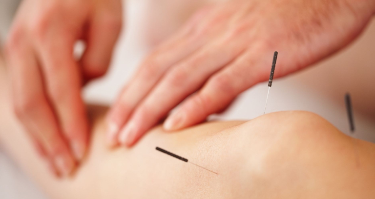 Dry Needling Acupunture For Leg Massage.