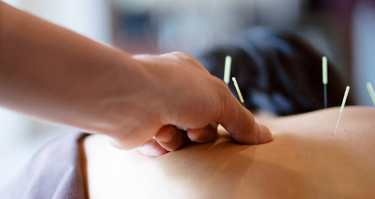 Dry Needling Treatment For Back Pain.