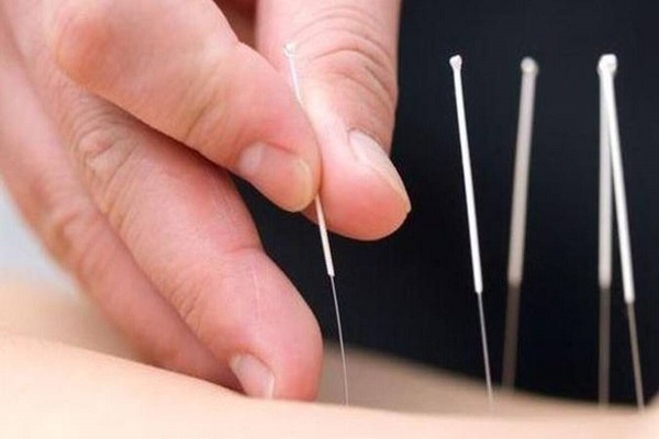 A Physiotherapist Doing Dry Needling Process For His Patient.