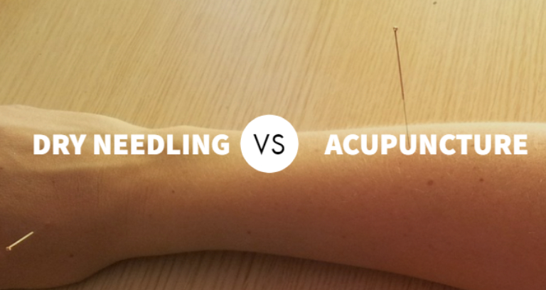 An Image Representing Acupuncture vs. Dry needling