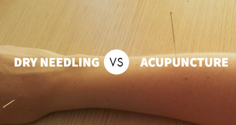 An Image Representing Acupuncture vs. Dry needling