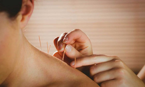 A Therapist Giving Dry Needling Treatment To His Patinet.