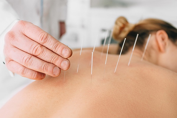 A Woman Undertaken Dry Needling Treatment.