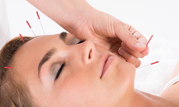 Facial Acupunture Treatment For Face - Taken By A Woman In A Therapy Room.